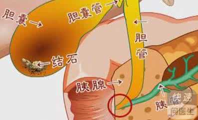 胆结石食疗 得了胆结石别害怕 用食疗+穴位按摩可碎石