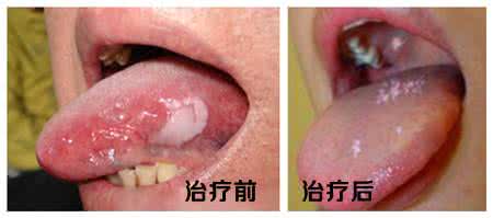 口腔黏膜白斑病 口腔白斑病 三方面诱发口腔长白斑