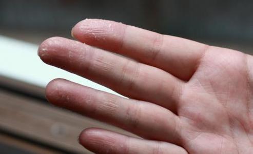治疗手足皲裂的偏方 手足皲裂怎么治