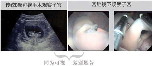 人流术后注意事项 产道维护型人流为幸福开道：产道维护型人流术的优势