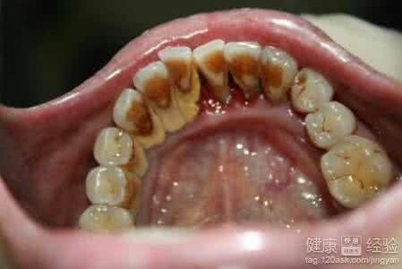 牙垢怎么去除 牙垢怎么去除 牙垢该怎么去除