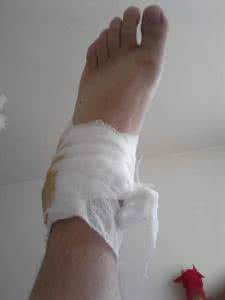 崴脚脖子怎么缓解 崴脚脖子