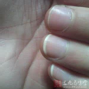 指甲上有白点 指甲上出现白点暗示健康亮“红灯”