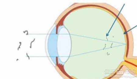 眼睛飞蚊症是怎么回事 眼睛飞蚊症治疗 眼睛飞蚊症是怎么回事？眼睛飞蚊症怎么治疗