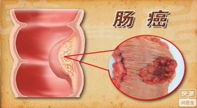 直肠癌的早期症状 肠癌的症状有哪些 了解肠癌的早期症状