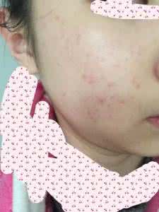 激素依赖性皮炎 激素依赖性皮炎 脸颊布满大脓包，会是脓包型激素依赖性皮炎吗？