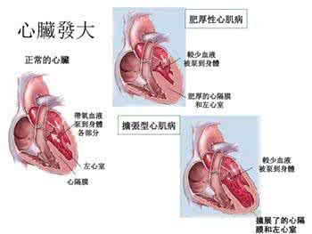扩张性心肌病的症状 扩张性心肌病 扩张性心肌病的病因