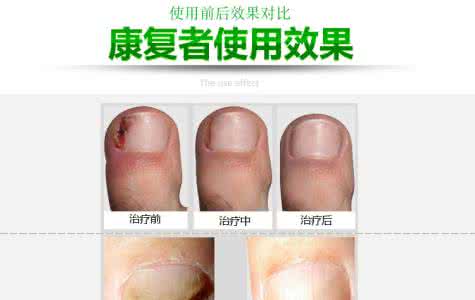 怎样快速去除灰指甲 去除灰指甲 怎样快速去除灰指甲?