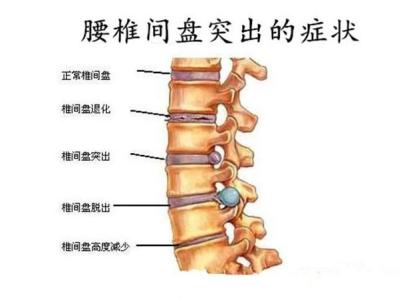 腰椎盘突出怎么治疗 腰椎盘突出怎么治疗 腰椎盘突出怎么治疗