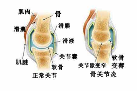 什么是退行性关节炎 退行性关节炎 什么因素导致的退行性关节炎