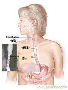 食道癌的早期症状 图文：食道癌十天见效