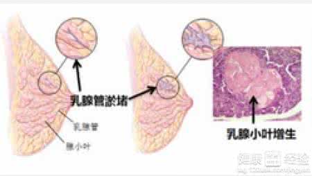 小叶增生的食疗方法 小叶增生怎么治疗 小叶增生的食疗方法