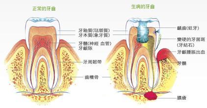 牙本质过敏的治疗 牙本质过敏的诊疗