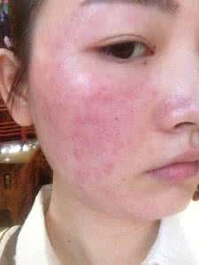 如何治疗激素性皮炎 激素皮炎 如何有效治疗激素皮炎