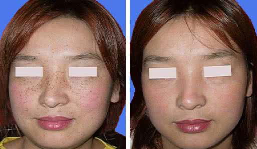 激光去除斑点 激光去除斑点 激光祛斑 6类斑点轻松去除