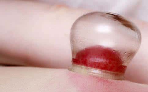 拔火罐后注意事项 拔火罐后的注意事项 夏天拔罐好吗?夏天拔罐后注意事项 拔火罐后的注意事项