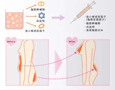 隆胸手术自体假体 隆胸手术自体假体 任叔解析丨自体脂肪隆胸与假体隆胸