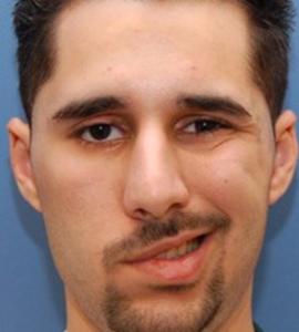 面瘫歪嘴康复训练视频 【转载】歪嘴风---面瘫，一剂而愈