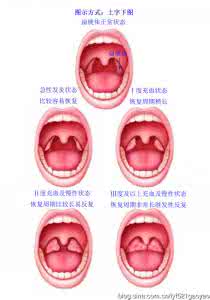 小儿扁桃体炎的常用药 小儿扁桃体炎的常用药 小儿扁桃体发炎吃什么药