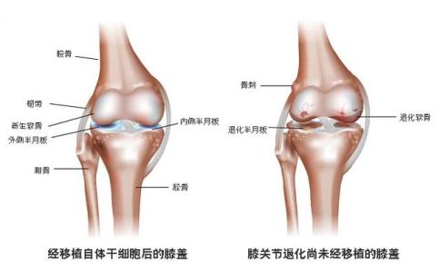 膝盖关节痛的原因 关节软骨磨损 膝盖、关节痛？软骨磨损是病根，给膝盖吃这些，80岁都健步如飞