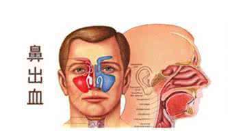 鼻出血的止血方法 鼻子出血怎么回事 鼻出血原因及防治法