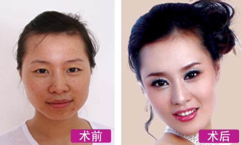 医治光子痤疮 光子医治痤疮是怎样的呢 日常要注意啥