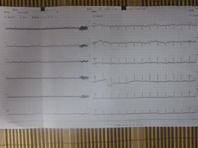 一度房室传导阻滞 一度房室传导阻滞 什么是一度房室传导阻滞