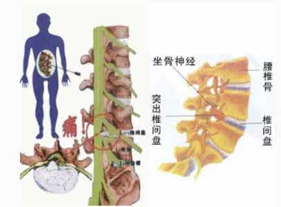 腰间盘突出脱出 腰间盘突出脱出 腰间盘脱出和突出有何区别 锻炼腰间盘的方法