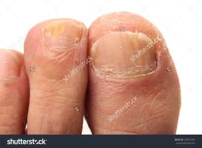 如何预防真菌感染 真菌感染 真菌感染是如何分类的