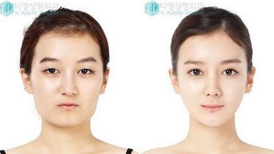 面部吸脂价位多少钱 面部吸脂 面部吸脂多少钱