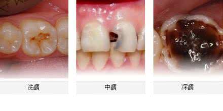 虫牙如何治疗 虫牙到底应该如何治疗呢？
