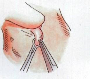男子结扎手术 男子结扎手术震撼揭秘