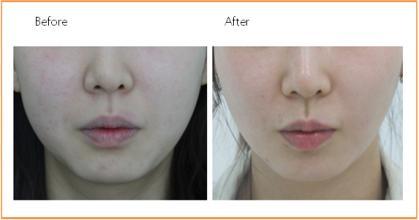 激光溶脂手术费用 激光溶脂的危害 激光溶脂费用大致多少