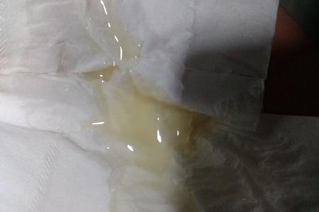 弱精引起的原因 男子精液偏黄是什么原因造成的