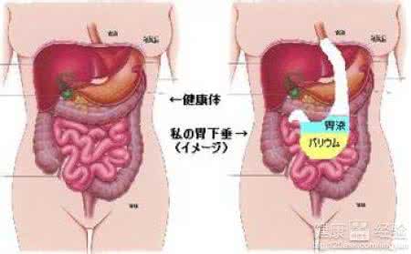 胃下垂中医治疗 胃下垂怎么办 中医如何治疗胃下垂