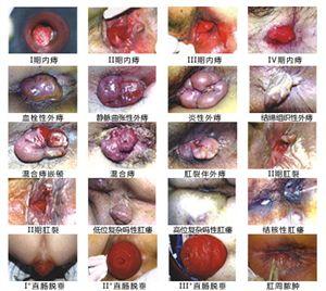 治痔疮偏方绝招 治内痔绝招