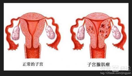 子宫腺肌症怎么治疗 子宫腺肌症怎么治疗 子宫腺肌症如何调理