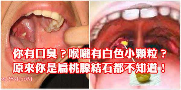 扁桃腺结石 扁桃腺结石 扁桃腺结石怎么得的？