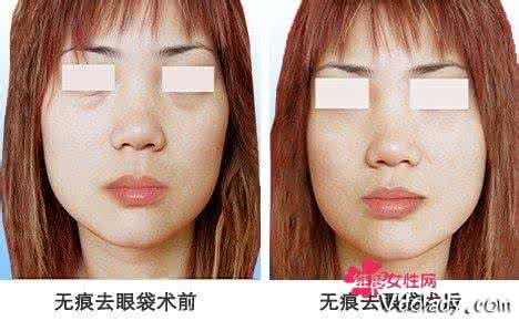 哪个年龄段适合做眼袋 哪个年龄段适合做眼袋 什么年龄适合做眼袋