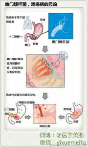 幽门螺杆菌临床意义 临床笔记 l 幽门螺杆菌，溃疡病的元凶
