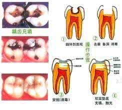 蛀牙了有个大洞牙痛怎么办 蛀牙引起牙痛怎么办