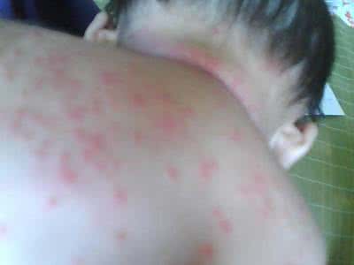 小孩起热痱子怎么办 小孩起痱子 小孩热痱子怎么治比较好？
