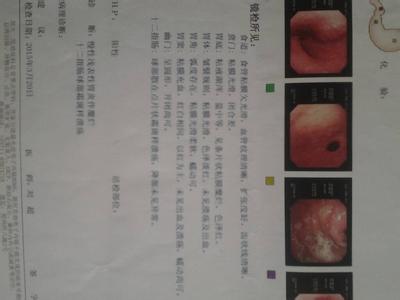 胃溃疡和反流性食管炎 国宝秘方：胃食管炎胃溃疡统统断根验方半夏泻心汤