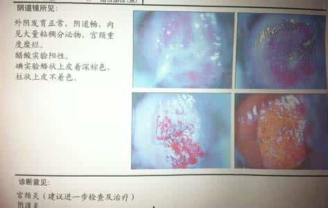 重度子宫糜烂症状 重度子宫糜烂症状有哪些