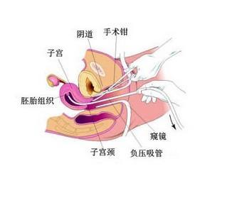 不孕症能治好吗 不孕症和刮宫有关系吗