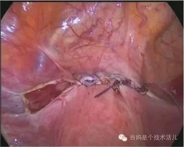 剖腹产后如何排大便 剖腹产后排便的时间