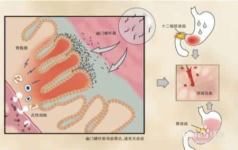 感染幽门螺杆菌的症状 幽门螺杆菌怎么感染的 感染幽门螺杆菌的症状