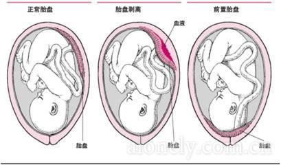 月经干净后同房又出血 顺产3个月同房出血 顺产后同房出血怎么回事