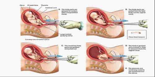 人流手术种类 女性人流手术原理是什么及其种类