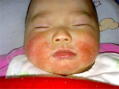 新生儿湿疹注意事项 新生儿湿疹注意事项 新生儿湿疹怎么办,注意事项很重要